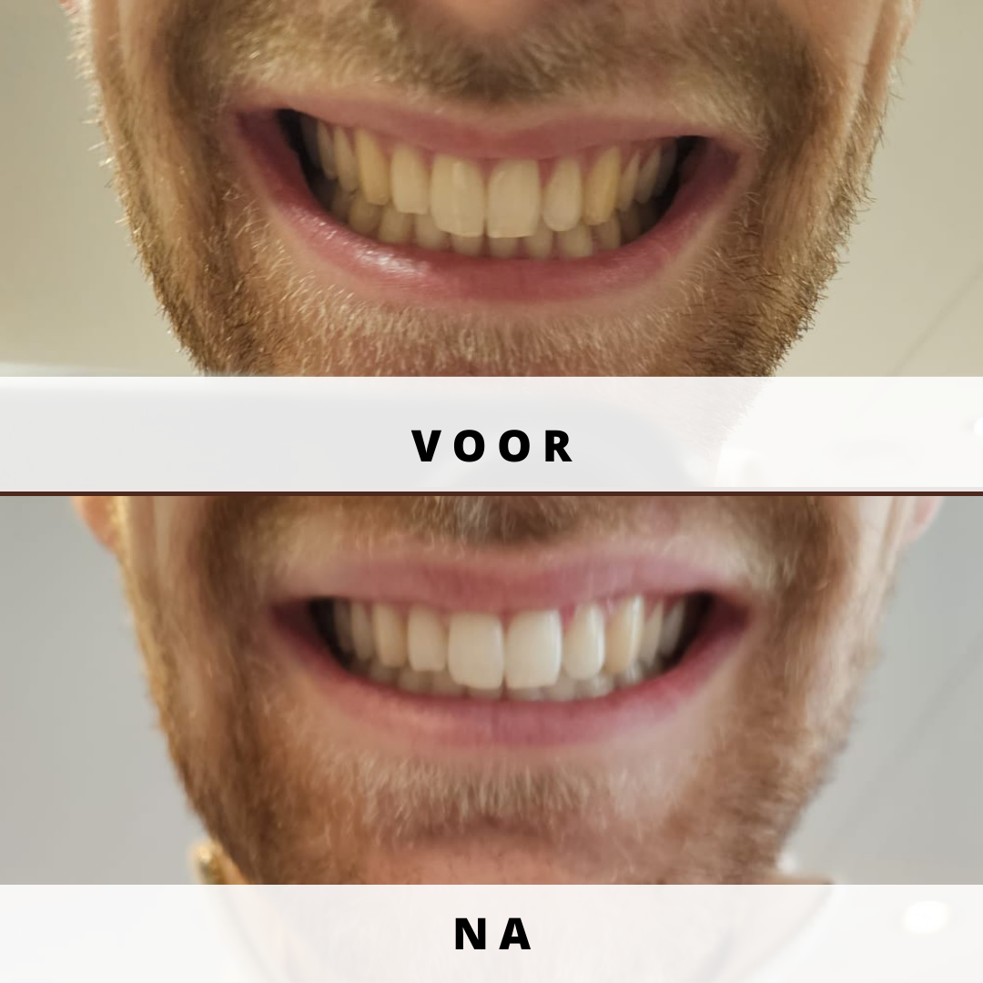 Tandenbleken Deluxe behandeling 10 tinten witter in 2x 20 minuten